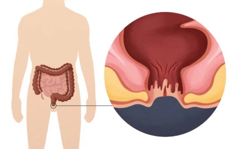 Dấu Hiệu Giúp Nhận Biết Sớm Bệnh Trĩ Không Nên Bỏ Qua